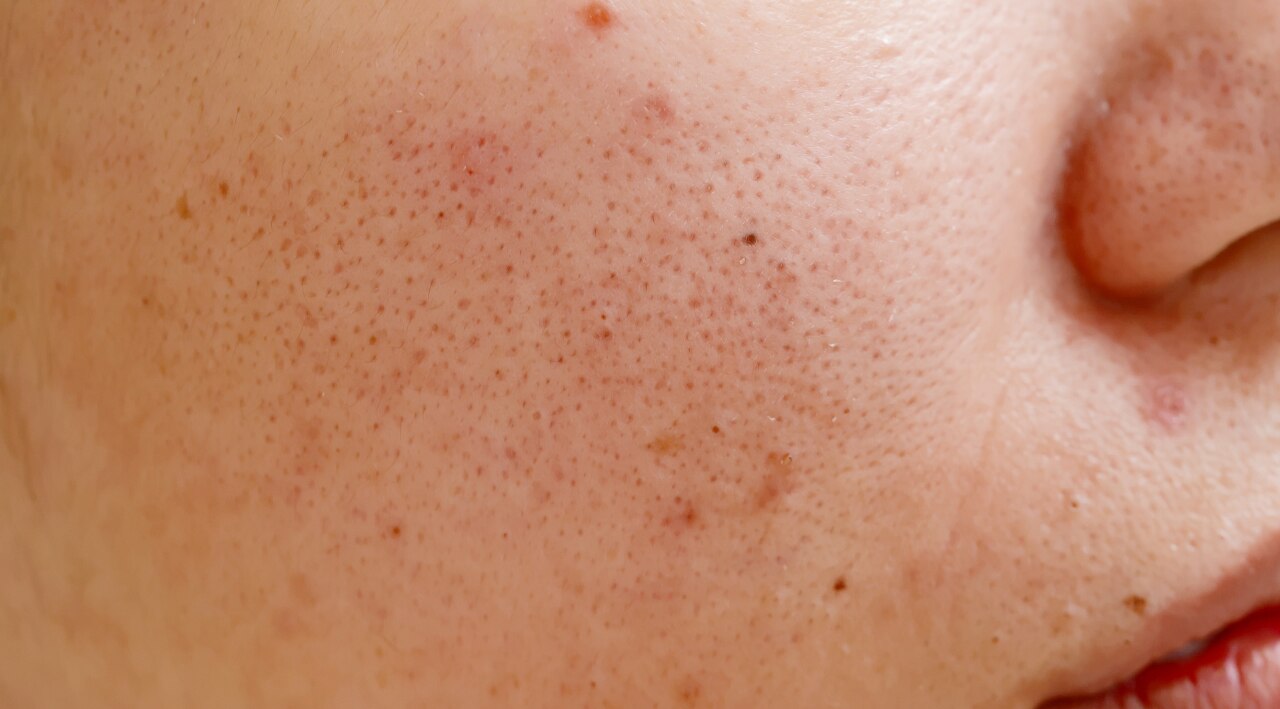 4. Spot Treatment