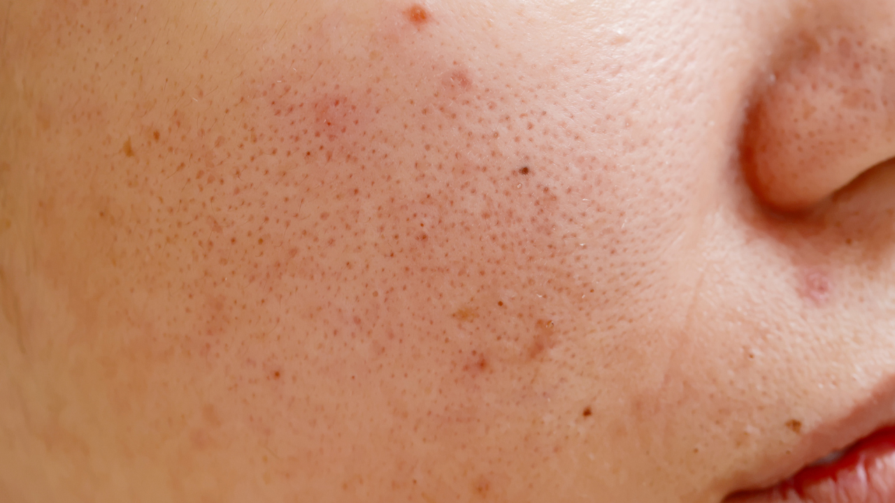 4. Spot Treatment