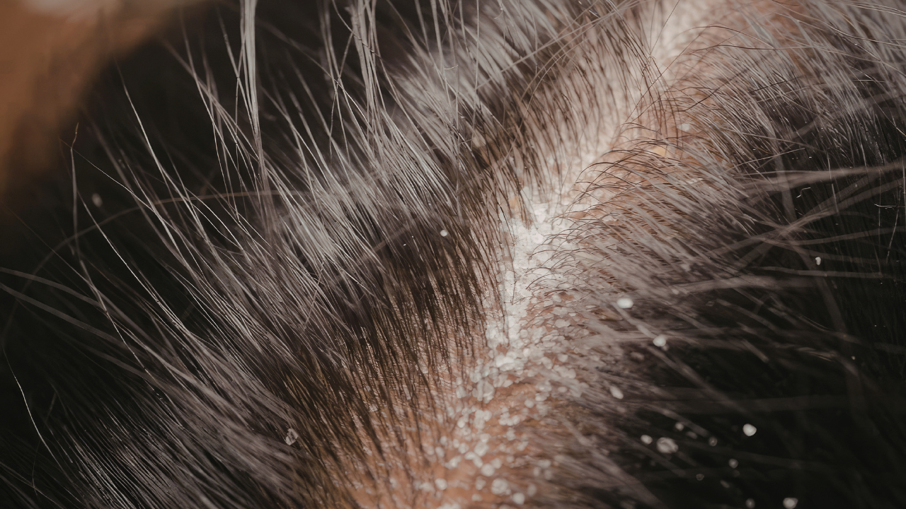 6. Dandruff & Scalp Care