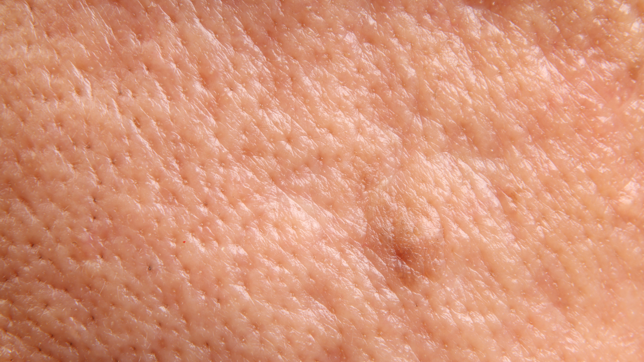 Combats Acne & Tightens Pores