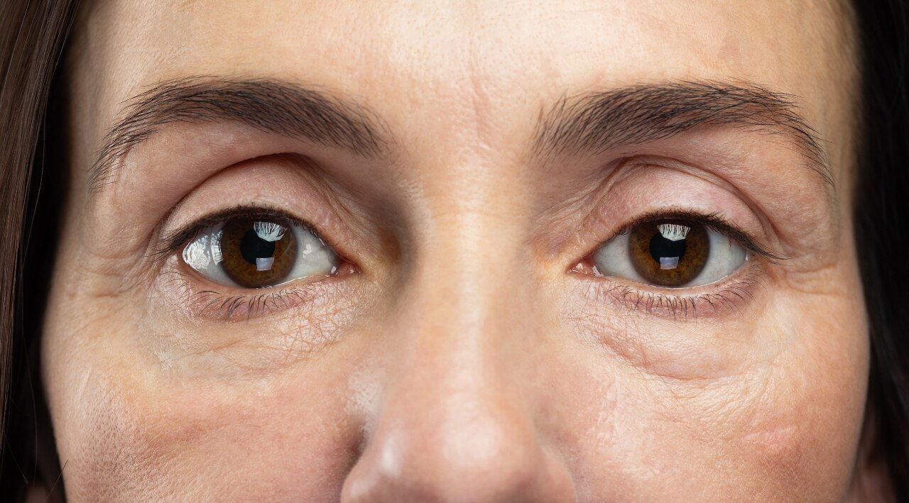 4. May Reduce Puffiness