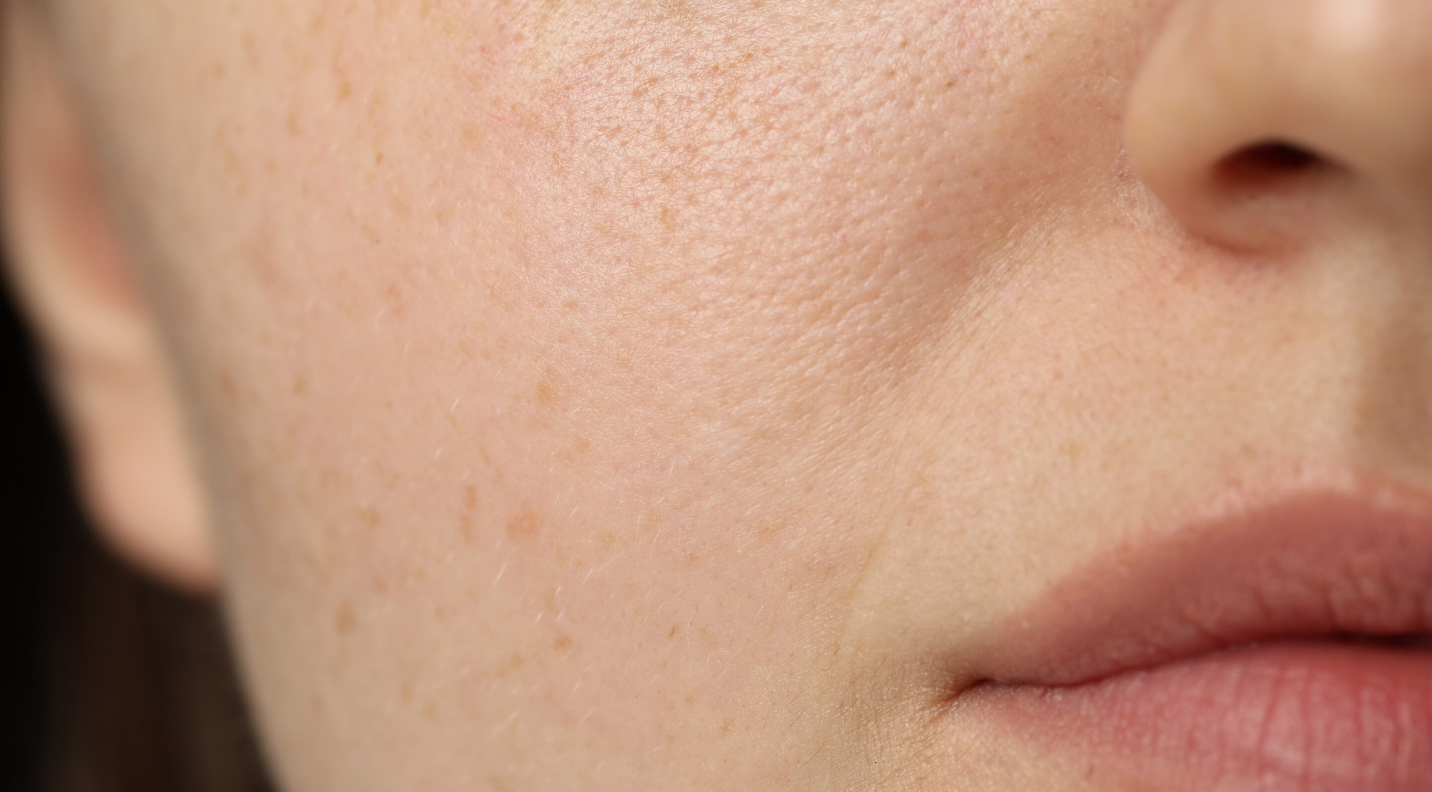 Causes of Open Pores