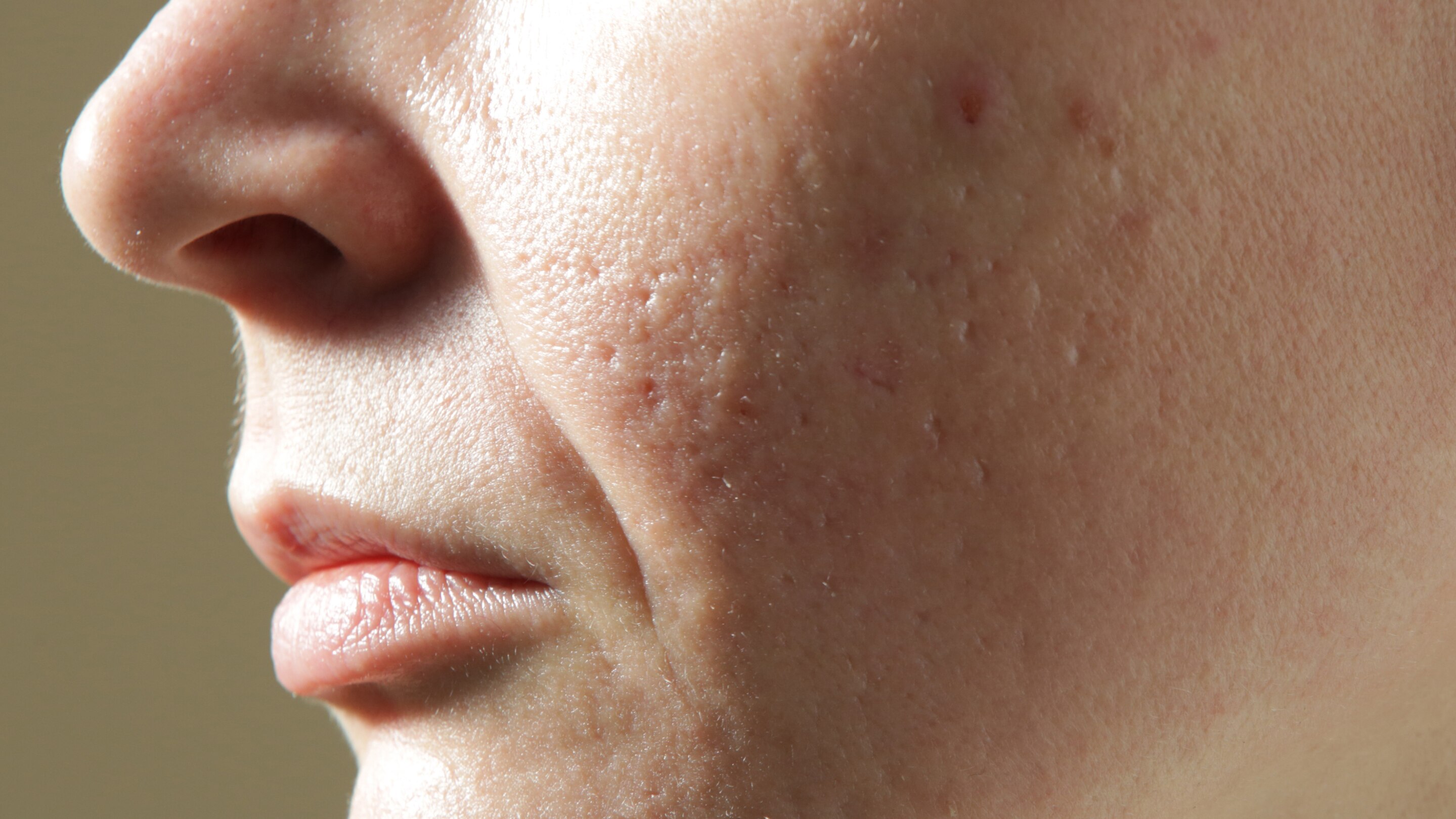 Why Open Pores Are a Common Concern