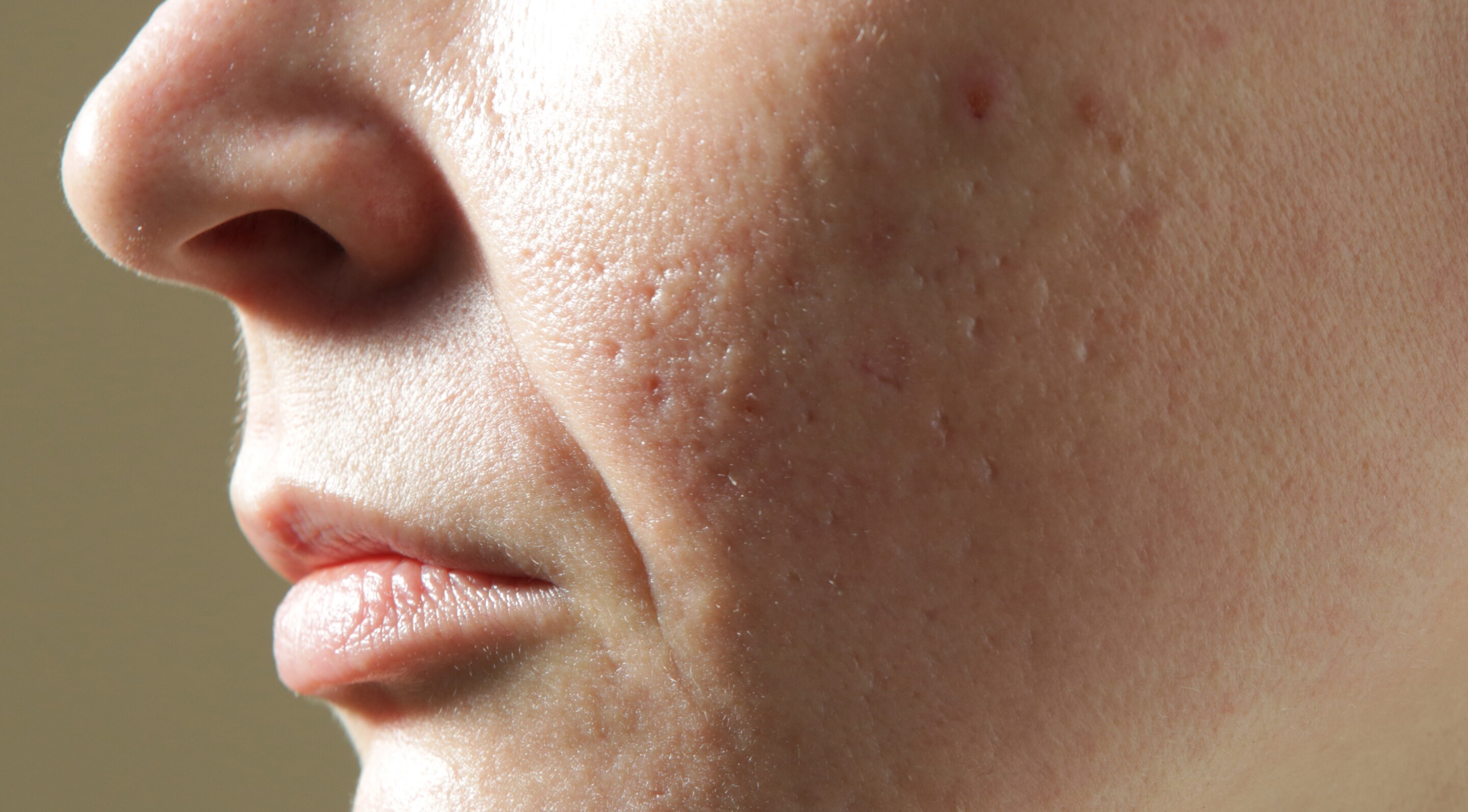 Why Open Pores Are a Common Concern
