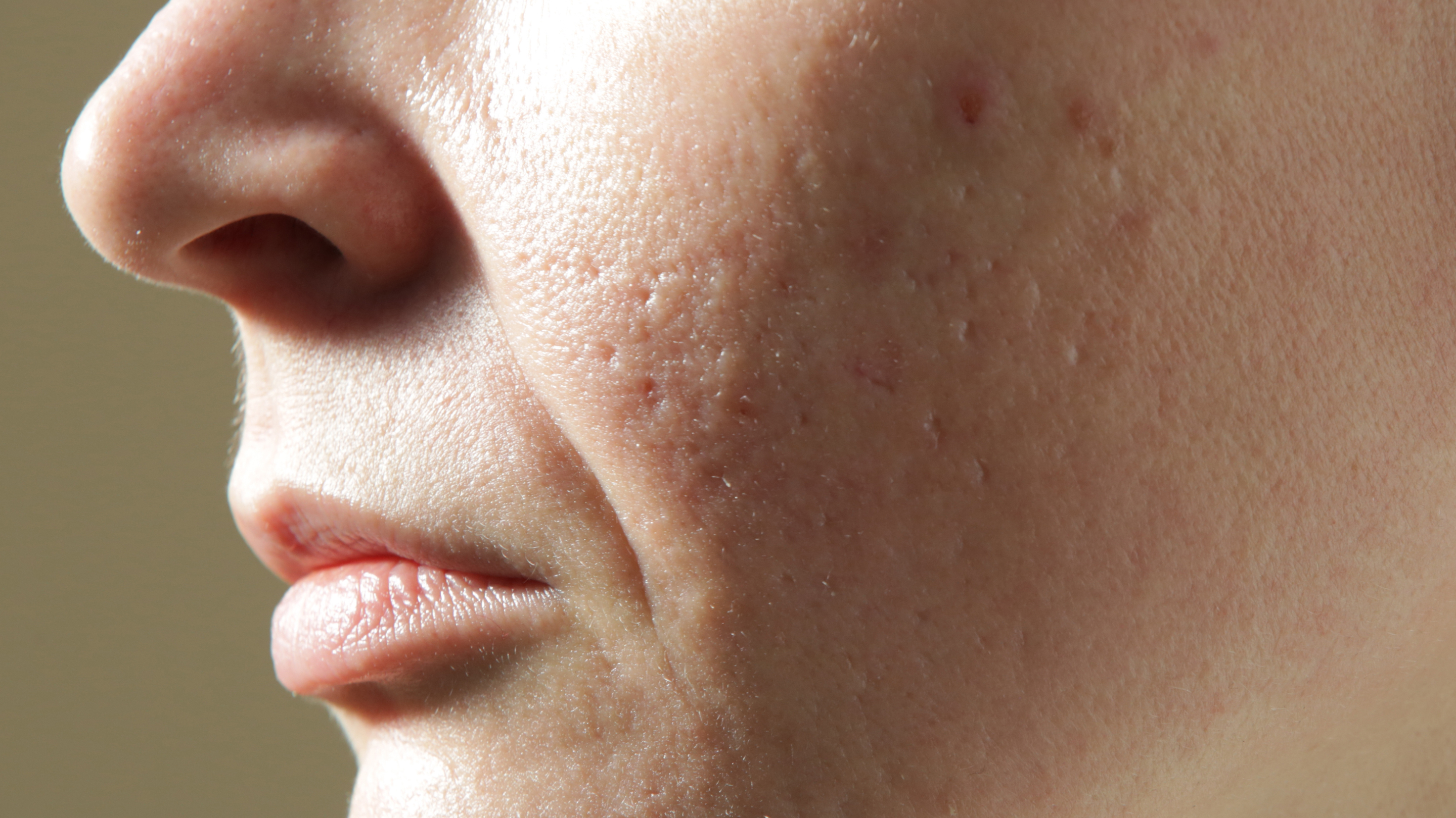 Why Open Pores Are a Common Concern