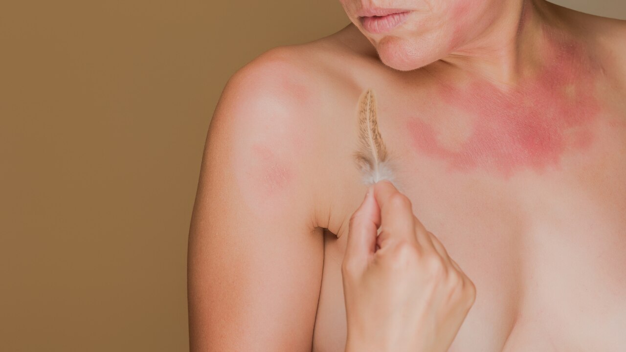 Allergic Reactions