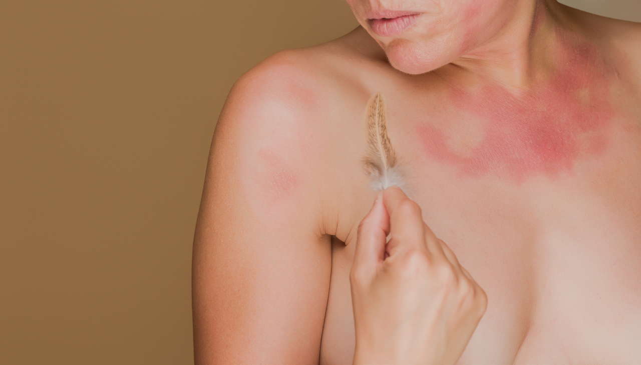 Allergic Reactions