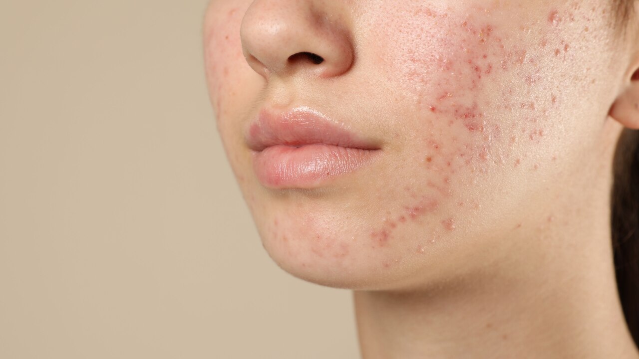 Acne Control: