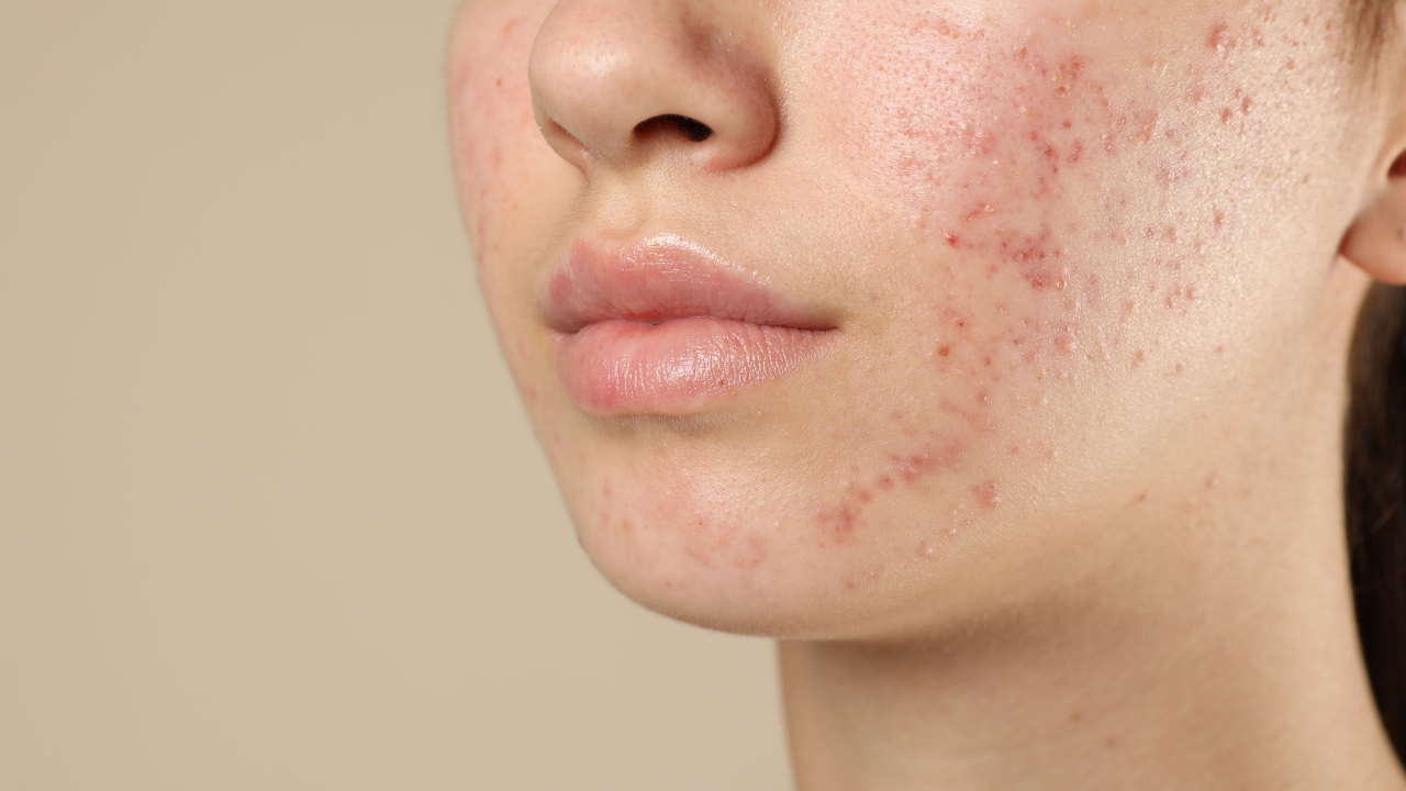 Acne Control: