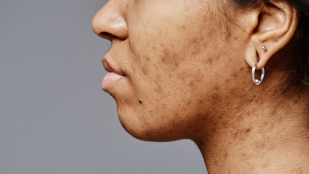 Minimizes Dark Spots: