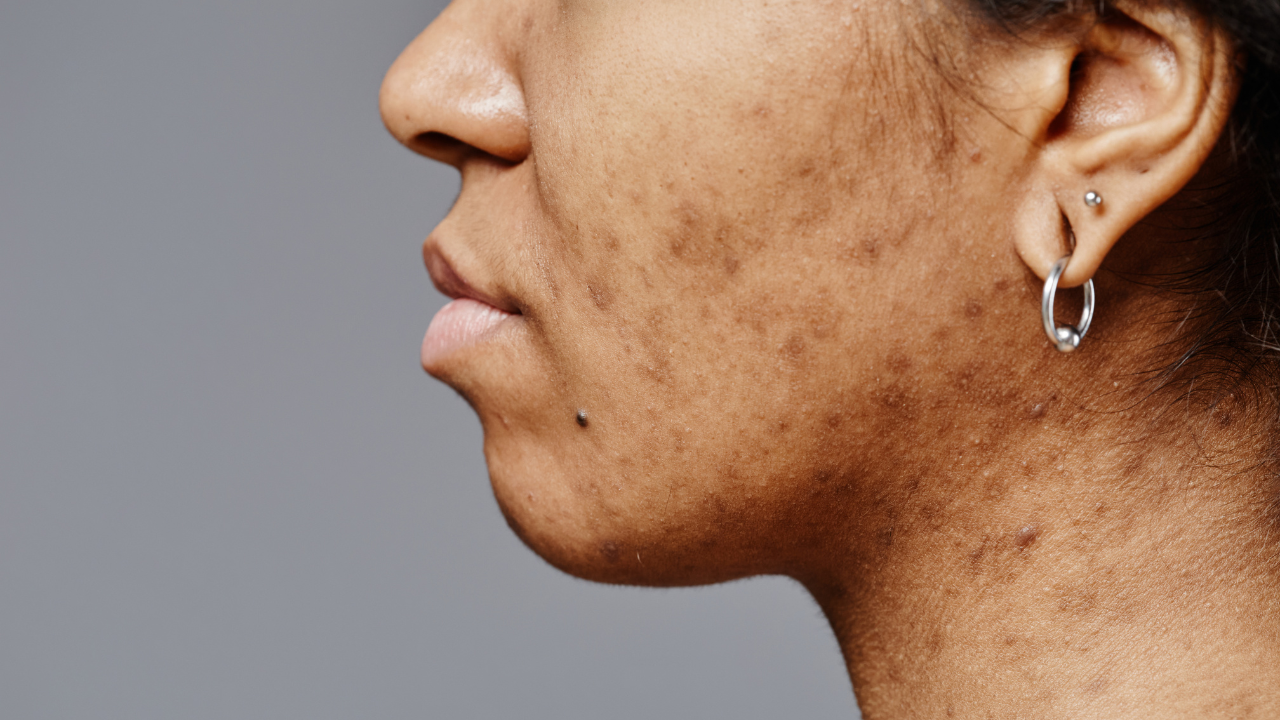 Minimizes Dark Spots: