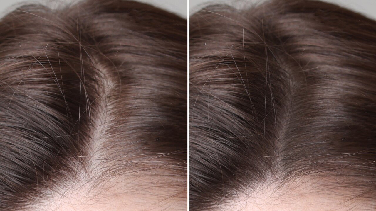 What Is Hair Density?