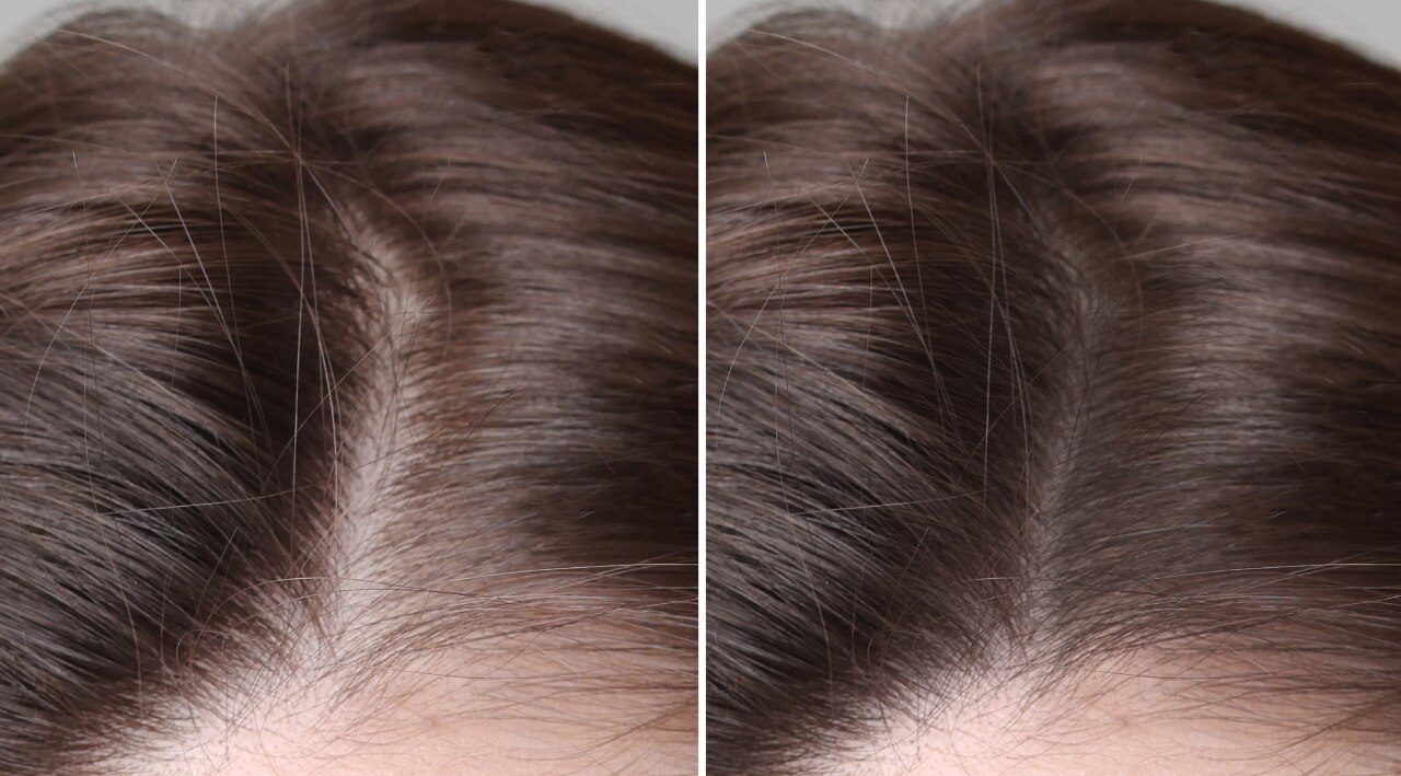 What Is Hair Density?