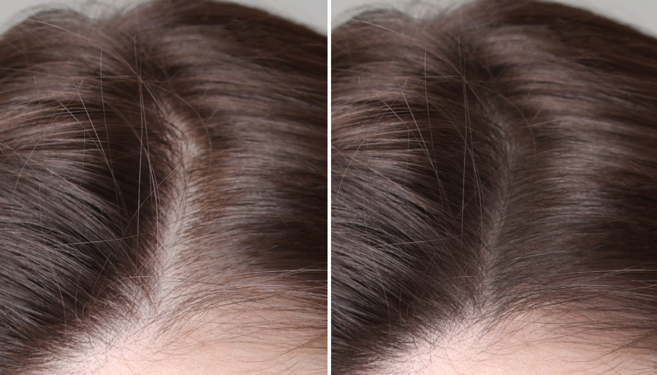 What Is Hair Density?