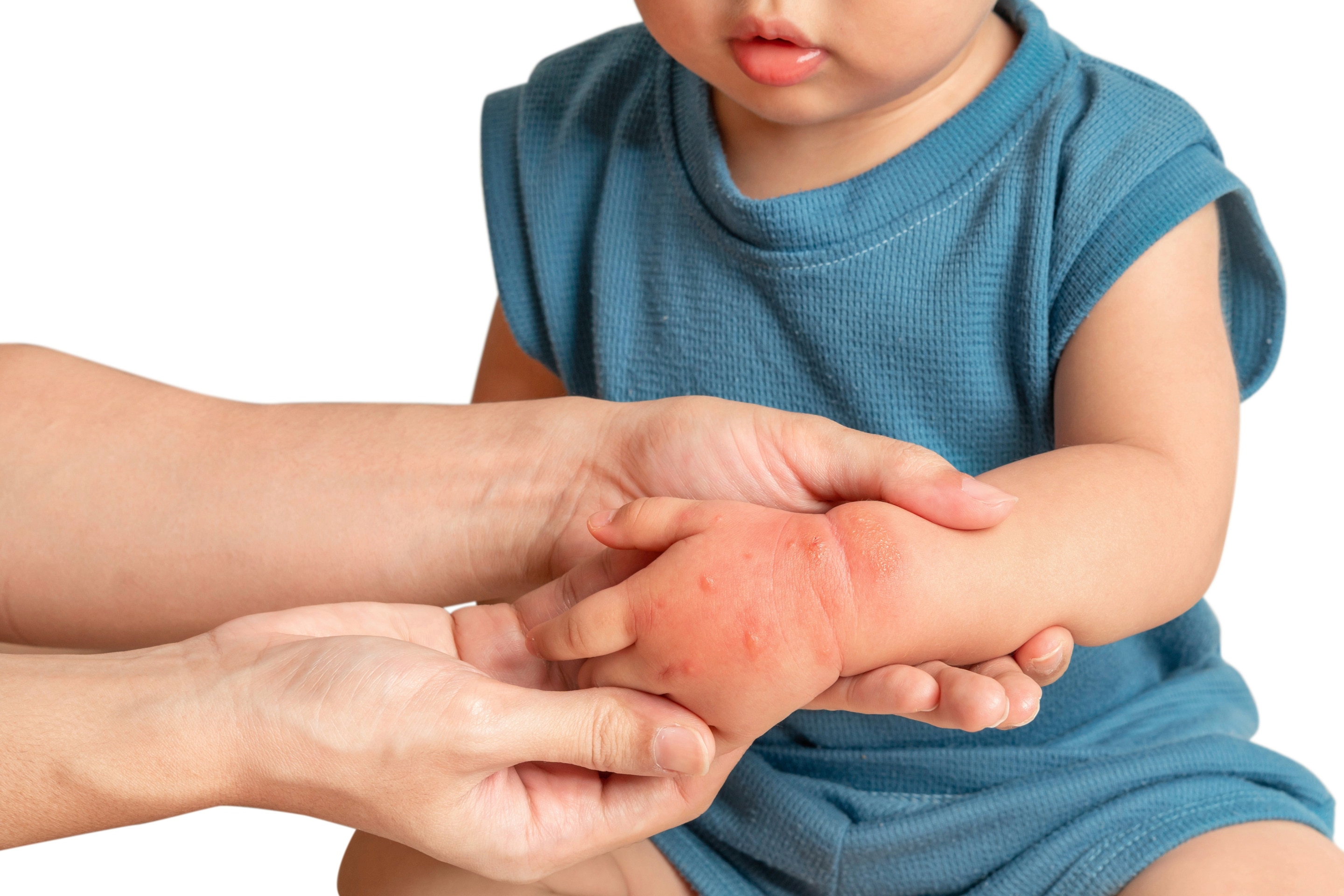 anak balita berbaju biru yang mengalami dermatitis kontak.