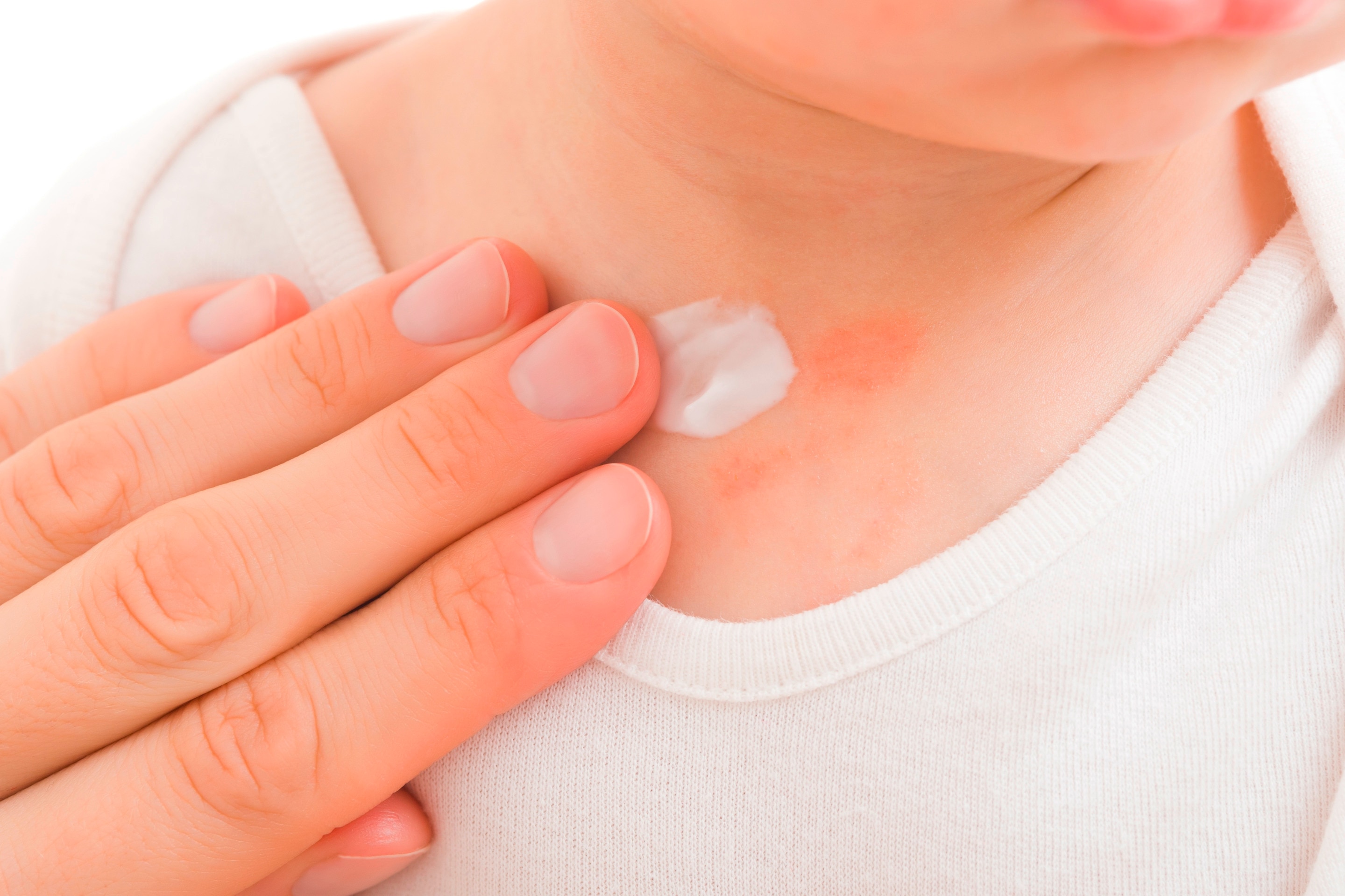 lotion dioleskan ke leher bayi dengan ruam kemerahan.