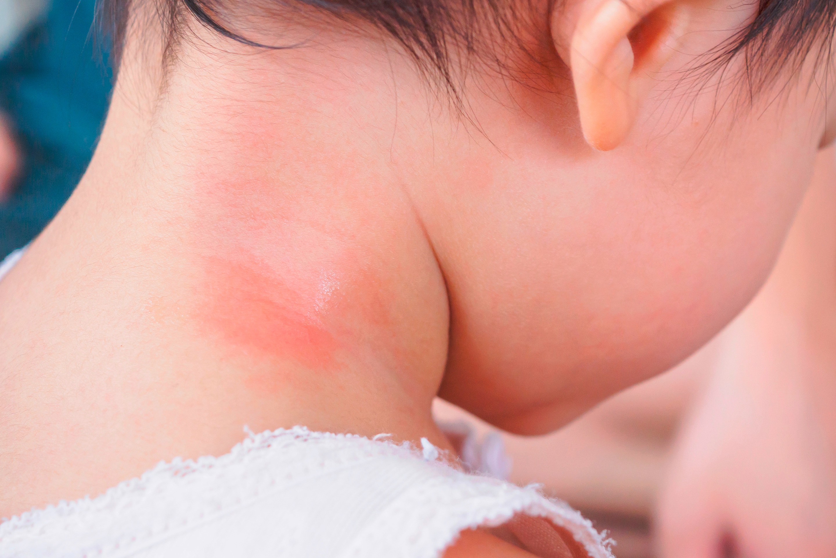Ada bayi dengan ruam kemerahan di lipatan leher.
