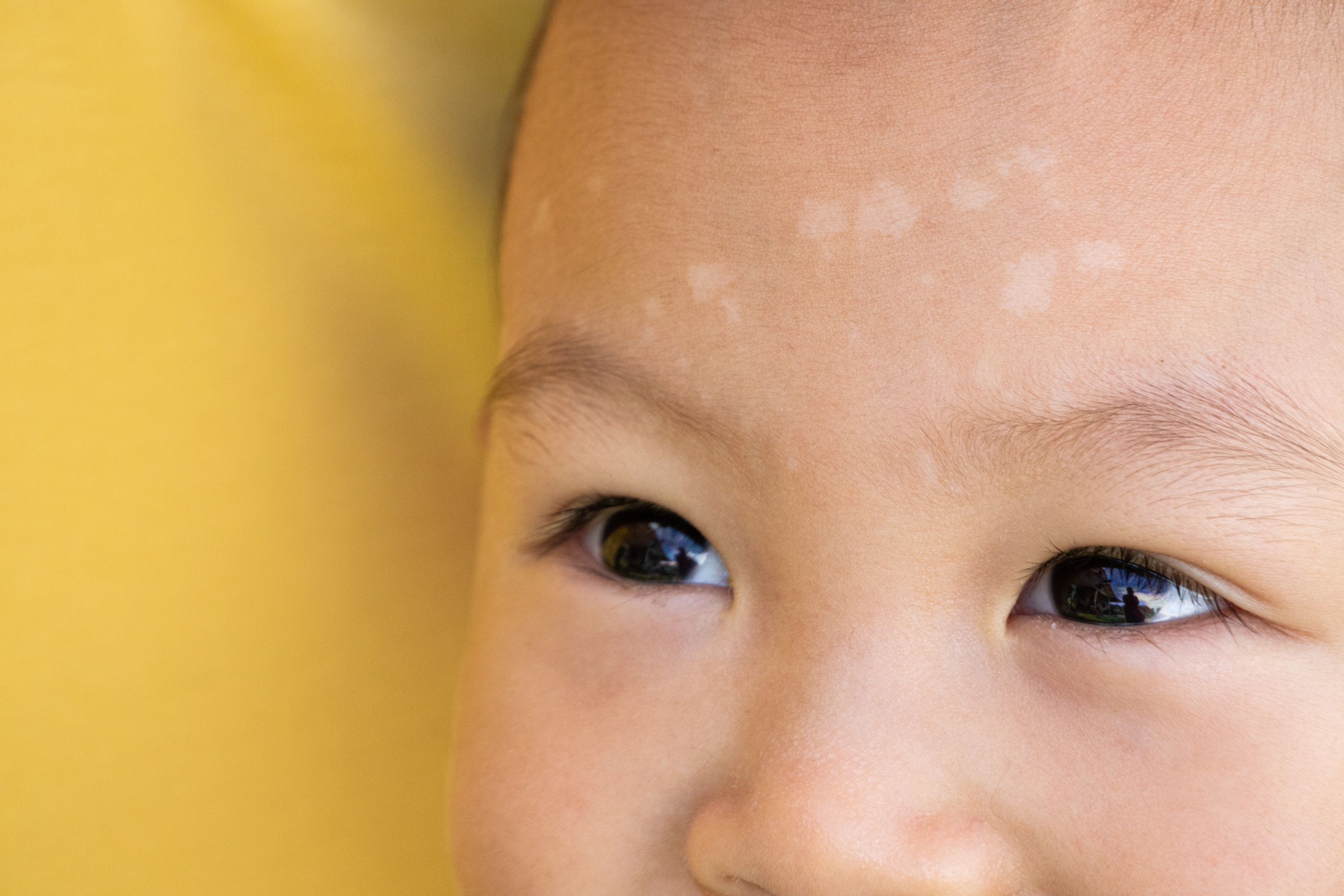 terlihat bercak putih pada kulit bayi di wajah.
