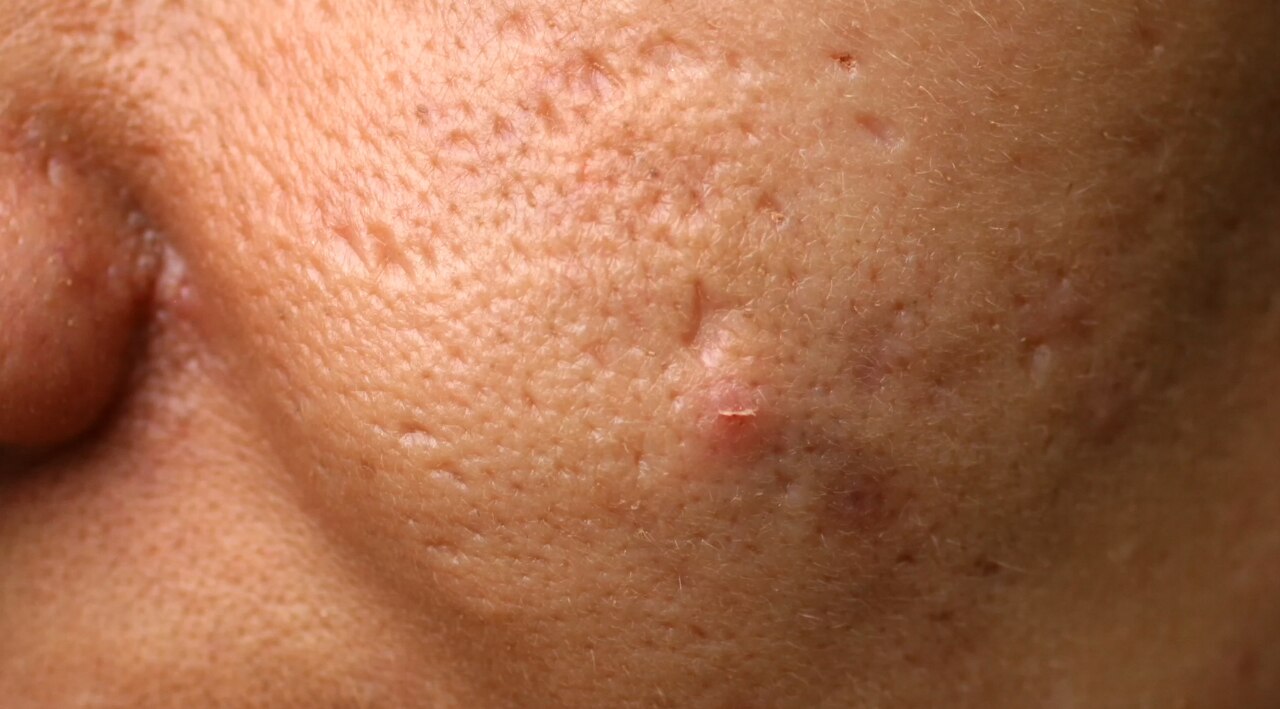 Acne Reduction and Prevention: