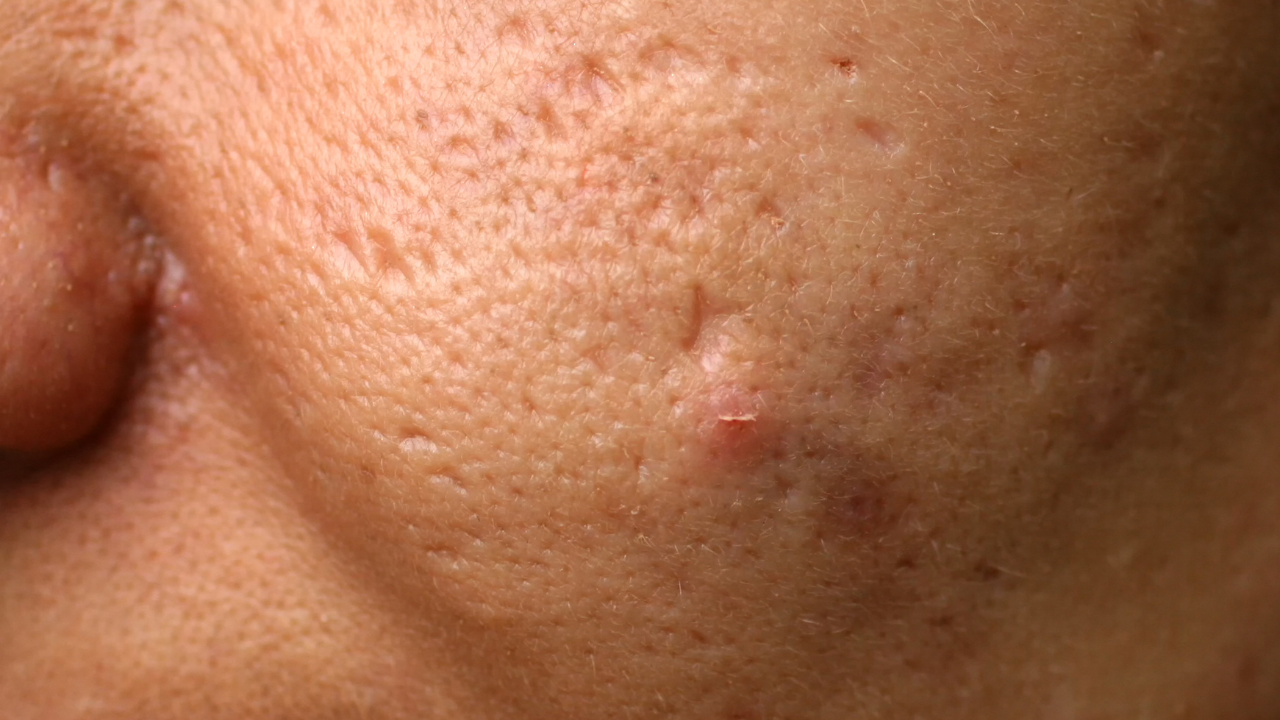 Acne Reduction and Prevention:
