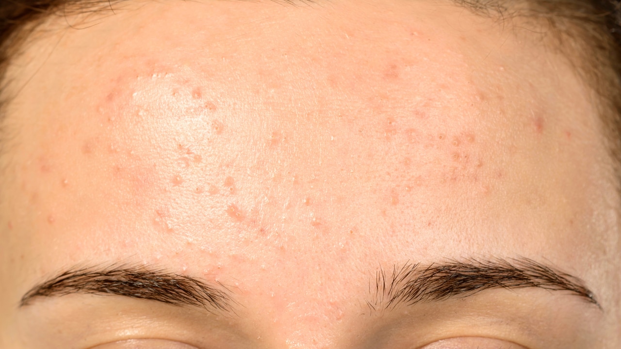 Soothing Irritation: