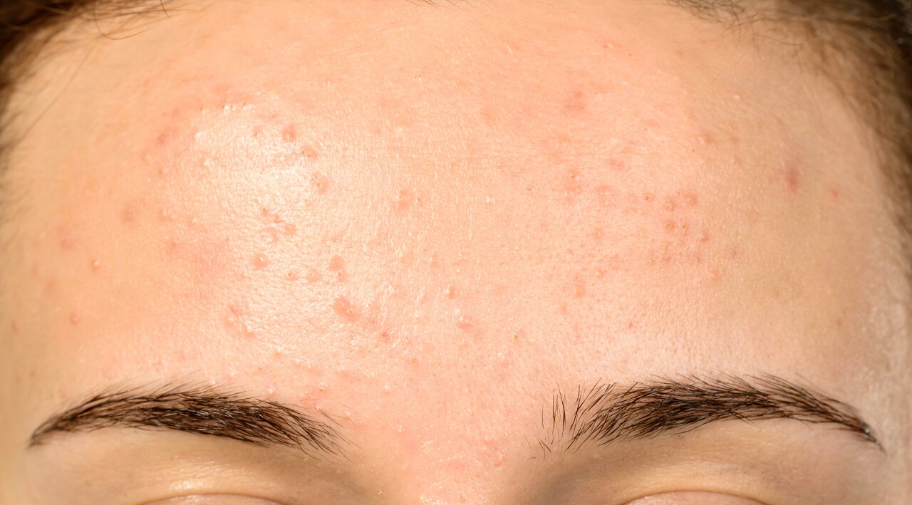 Soothing Irritation: