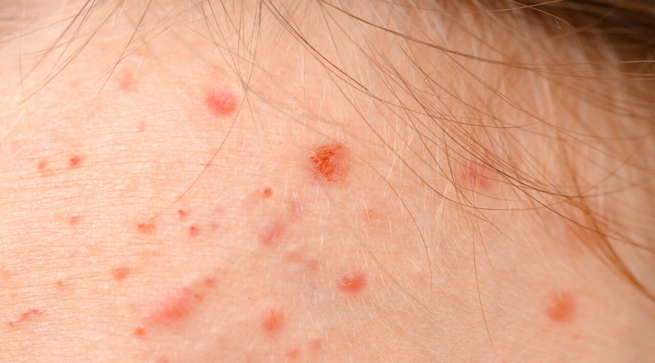Best for Acne-Prone Skin