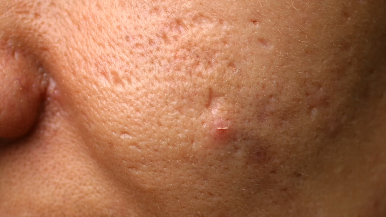 Can Manual Tools Help with Ageing and Acne?