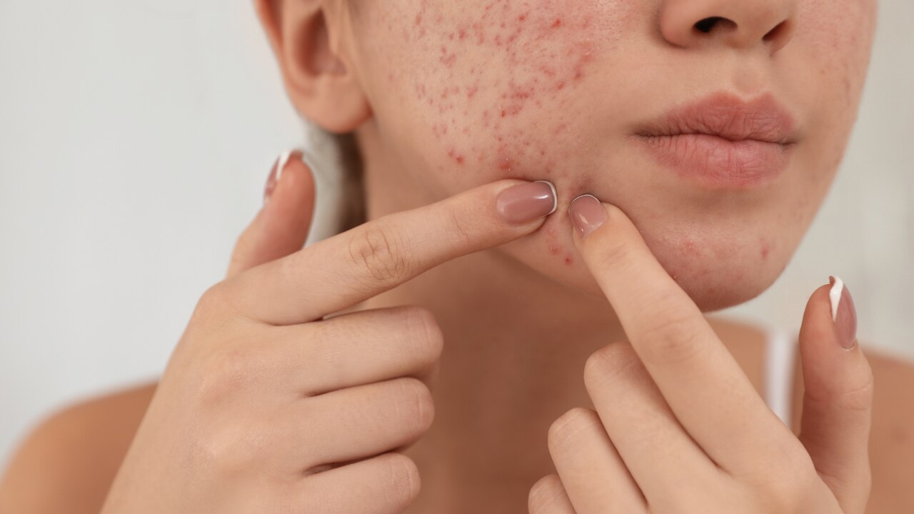 4. Masoor Dal Face Pack for Acne-Prone Skin