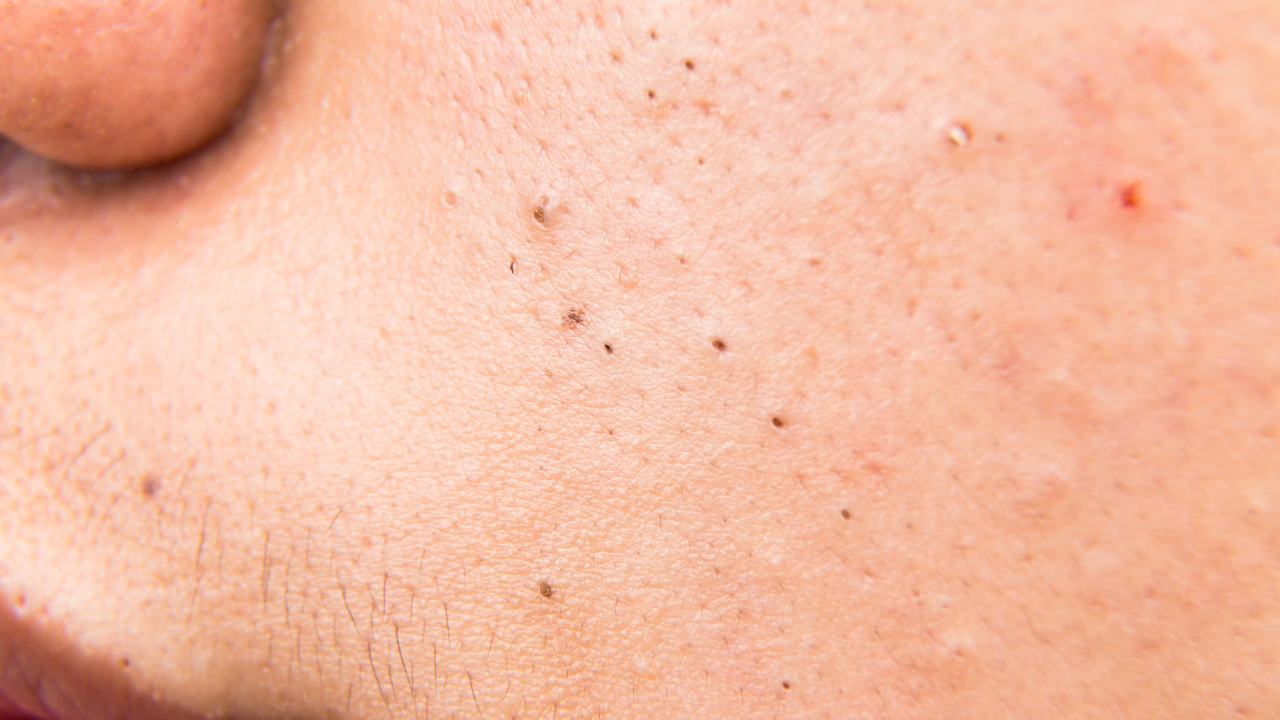Increased sweating leads to clogged hair follicles