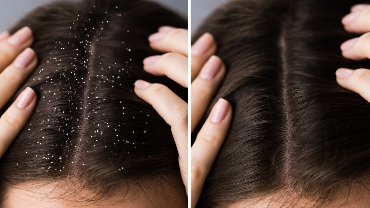 Maintain a healthy scalp