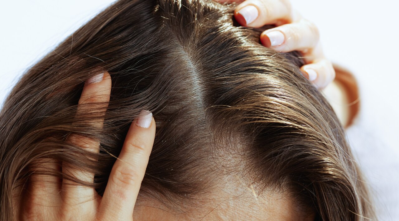 3. Sweaty Scalp