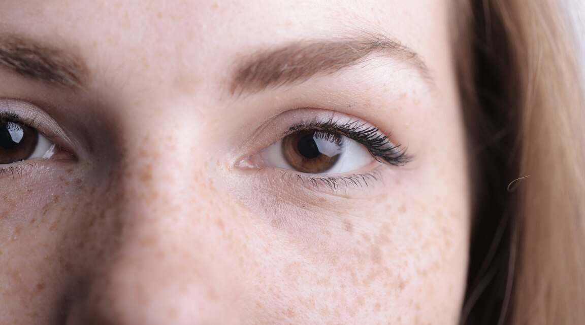 Freckles on Face Causes Treatment and Prevention Tips