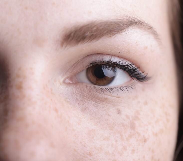 Image of Freckles on Face: Causes, Treatments, How to Remove & Prevention Tips