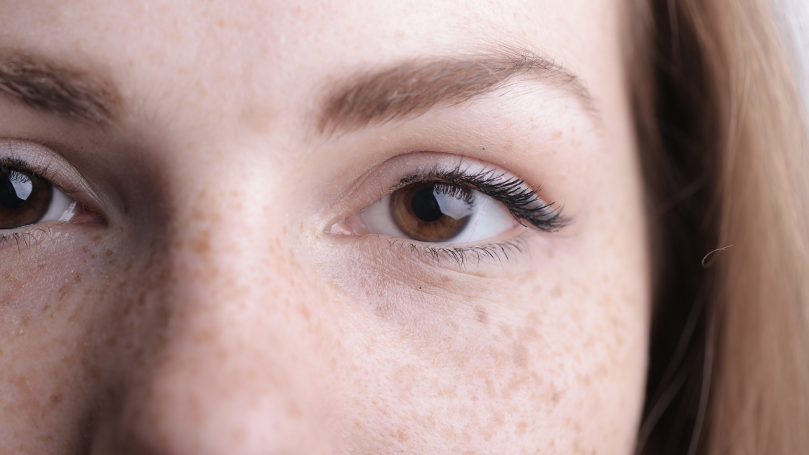 Freckles on Face Causes Treatment and Prevention Tips