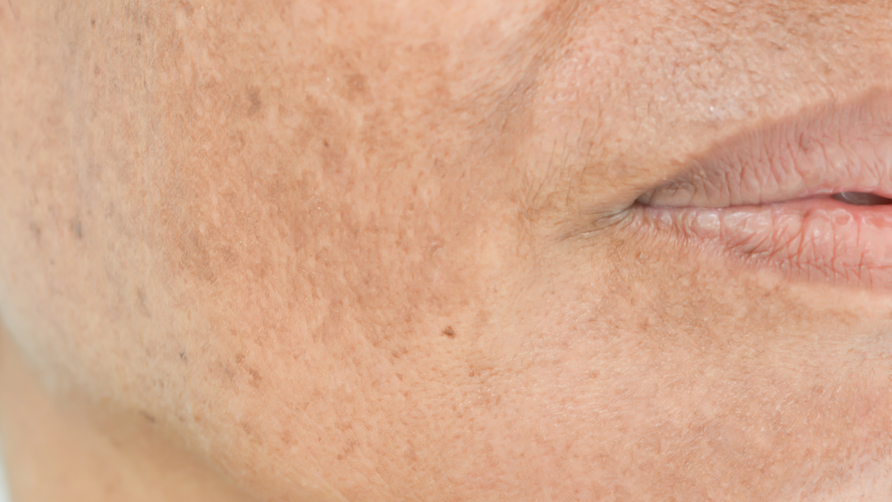 Common Mistakes That Make Freckles Darker