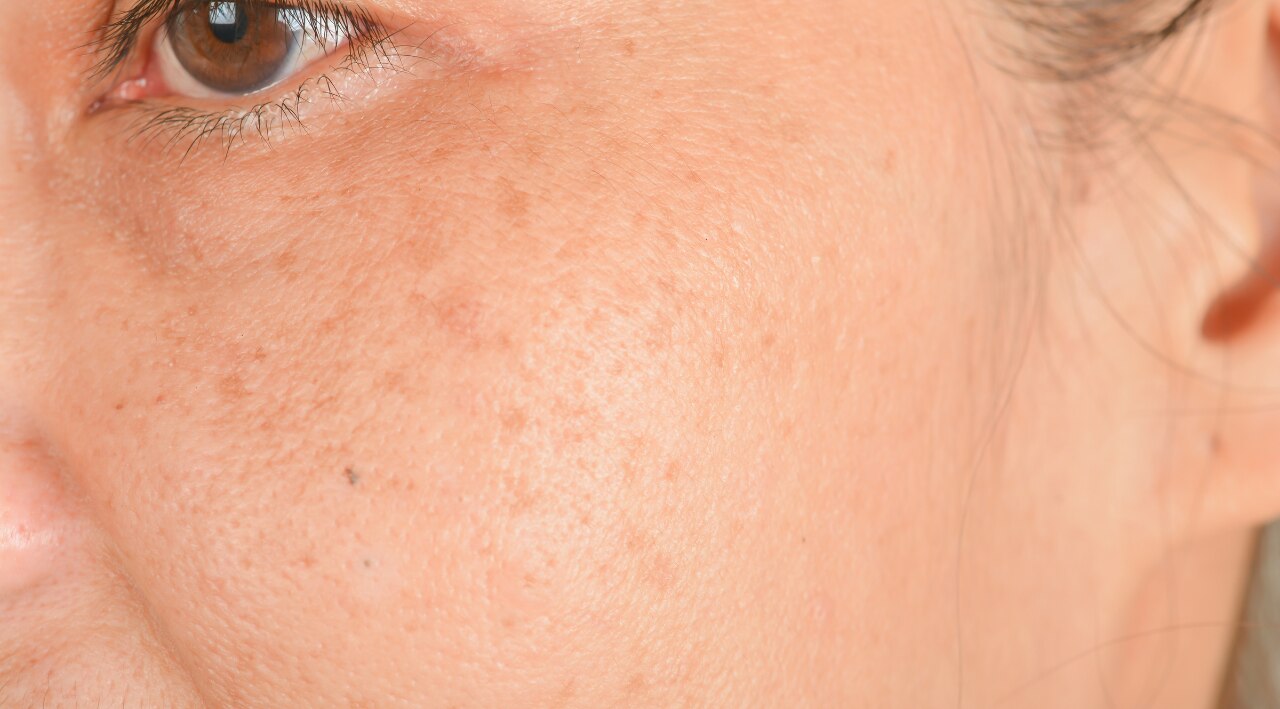 Ephelides (Simple Freckles)