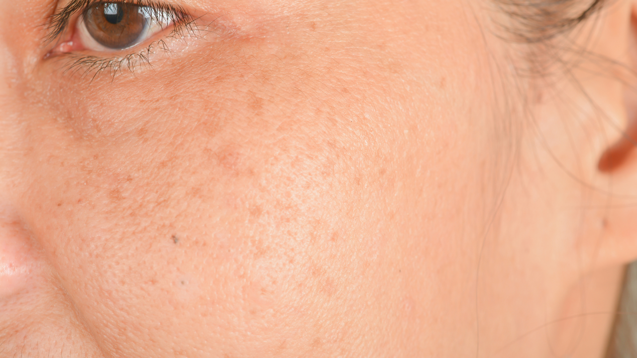 Ephelides (Simple Freckles)