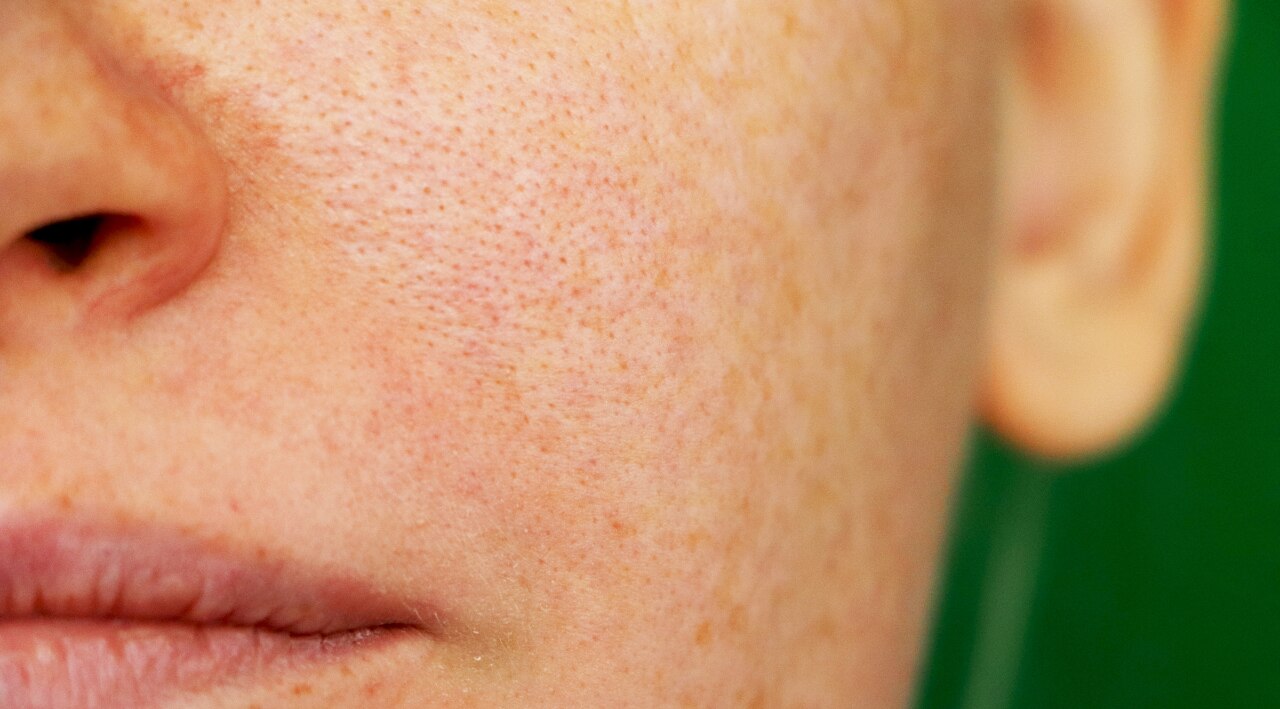 Solar Lentigines (Sunspots or Liver Spots)