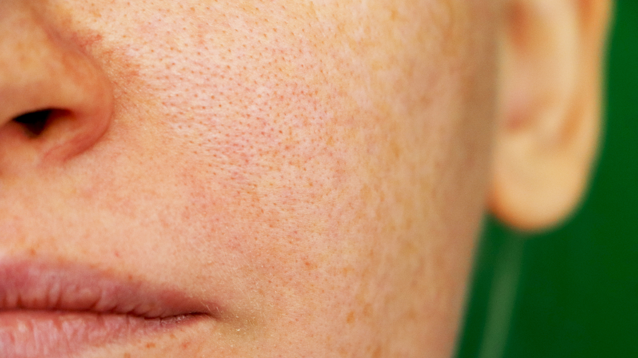 Solar Lentigines (Sunspots or Liver Spots)