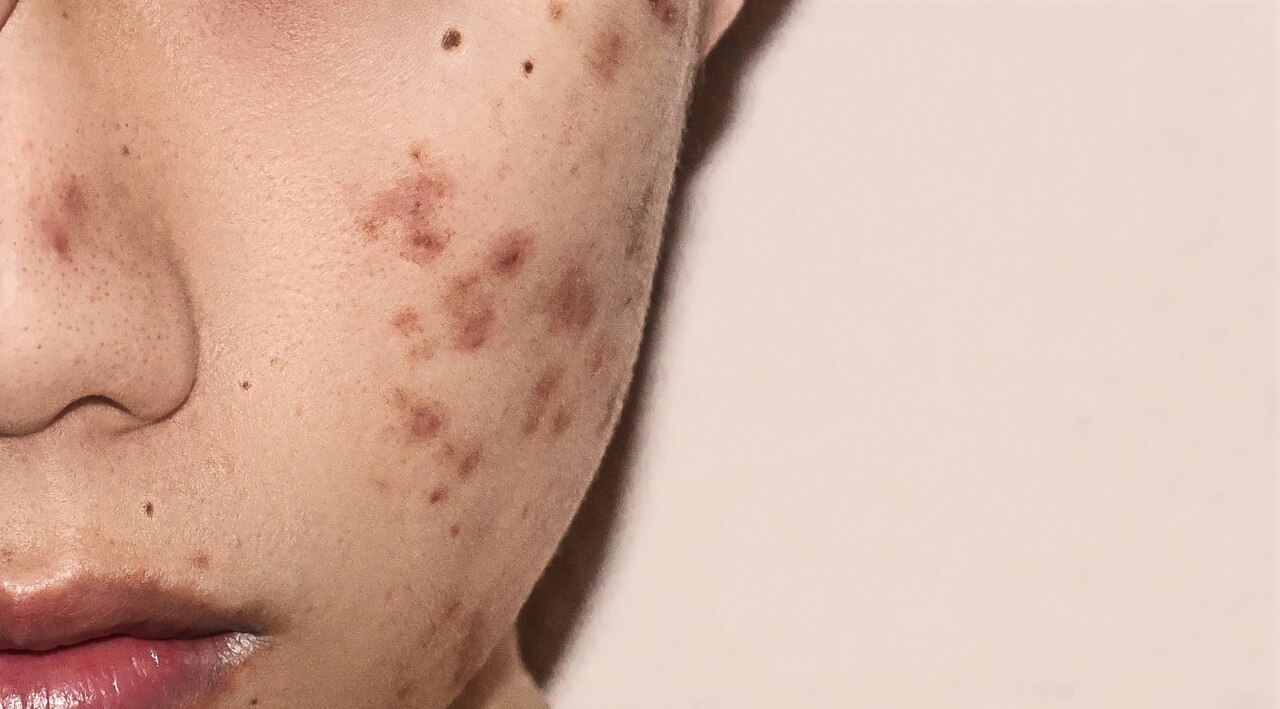 How the Gut May Affect Skin