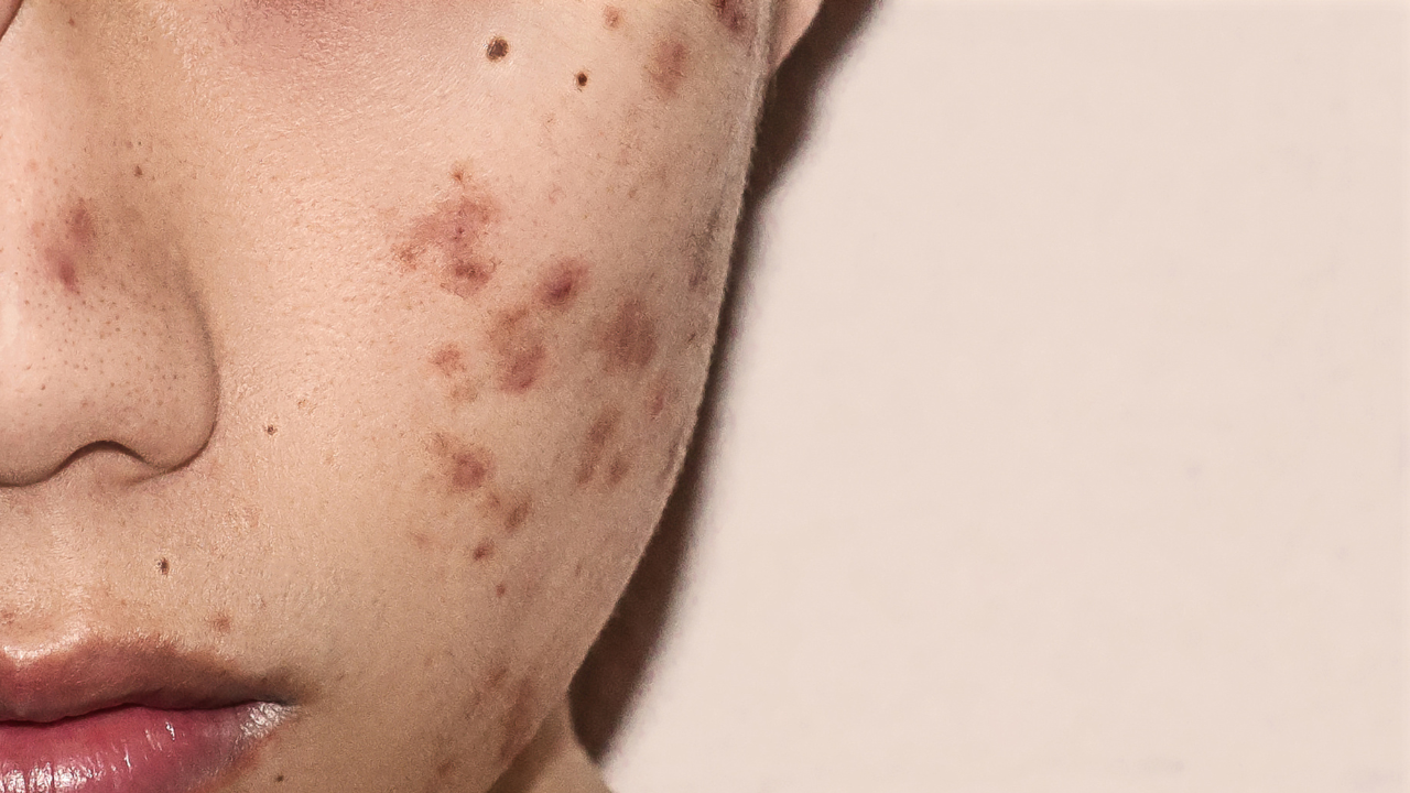 How the Gut May Affect Skin