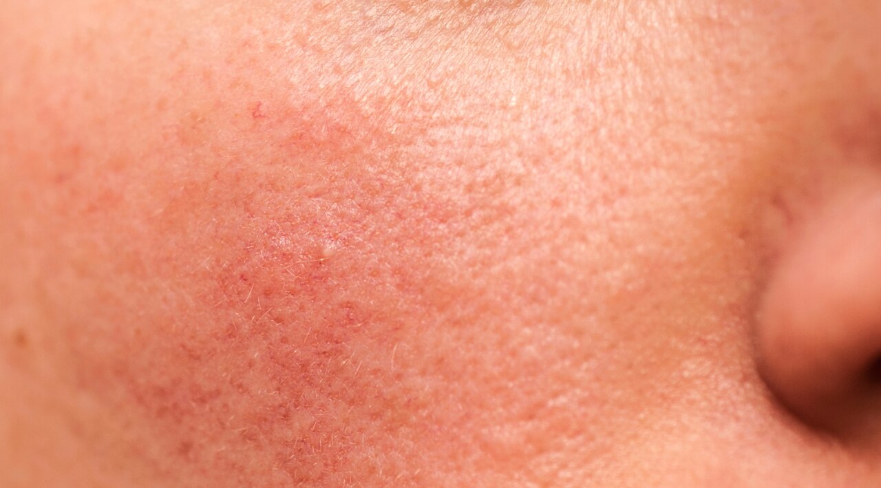 Signs Your Skin May Be Sensitive