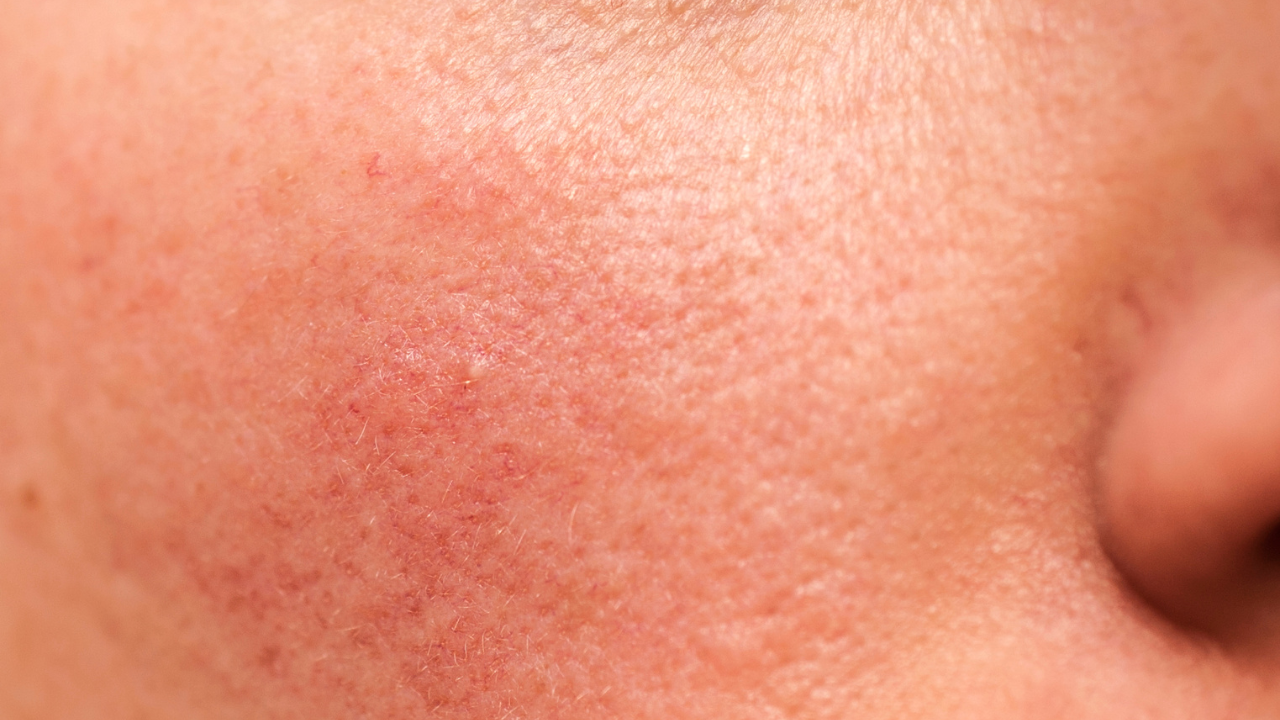 Signs Your Skin May Be Sensitive