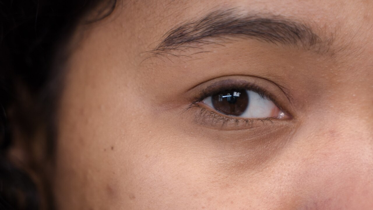 Everyday Puffiness vs Cortisol Face
