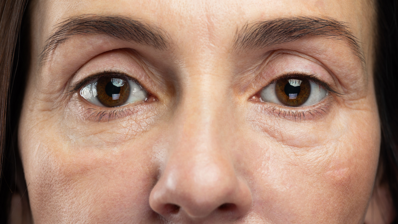 What Is Cortisol Face?