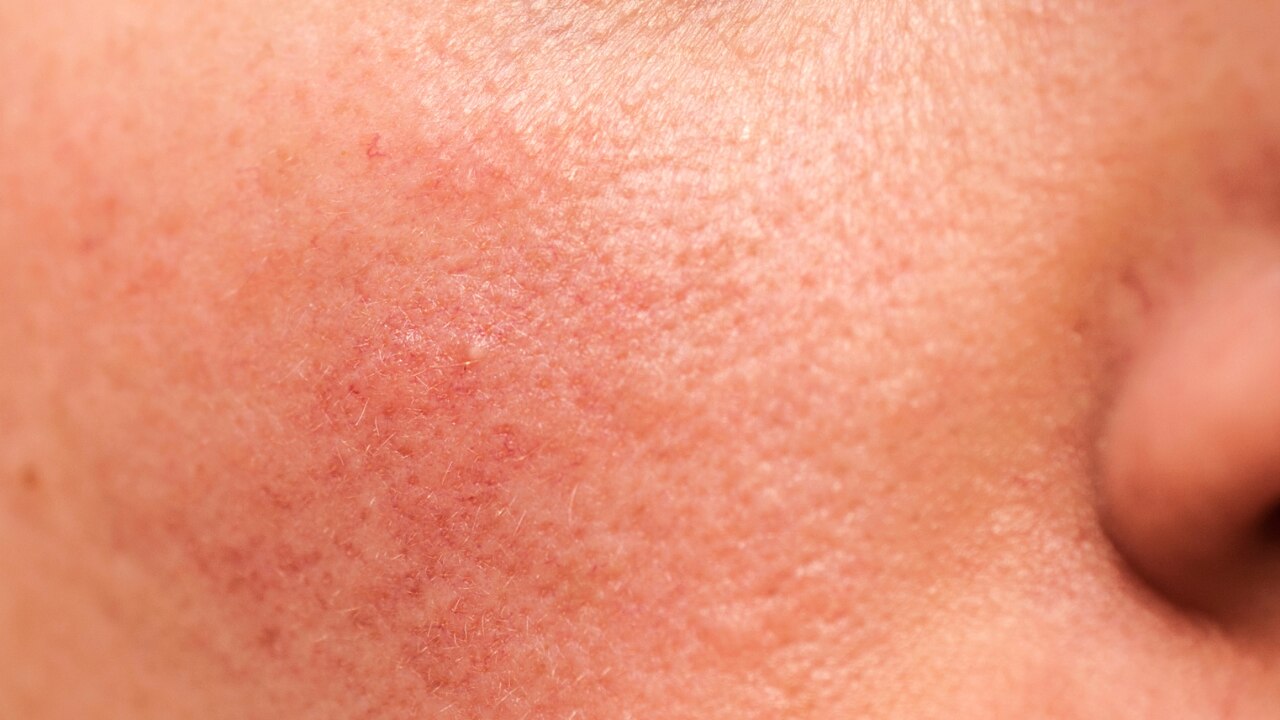 Fights Acne and  Breakouts