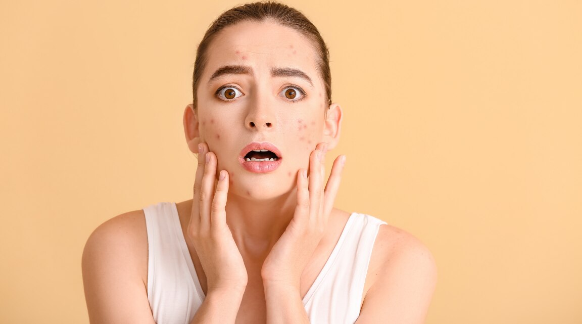 Cortisol Face Explained Stress and Skin Puffiness Effects