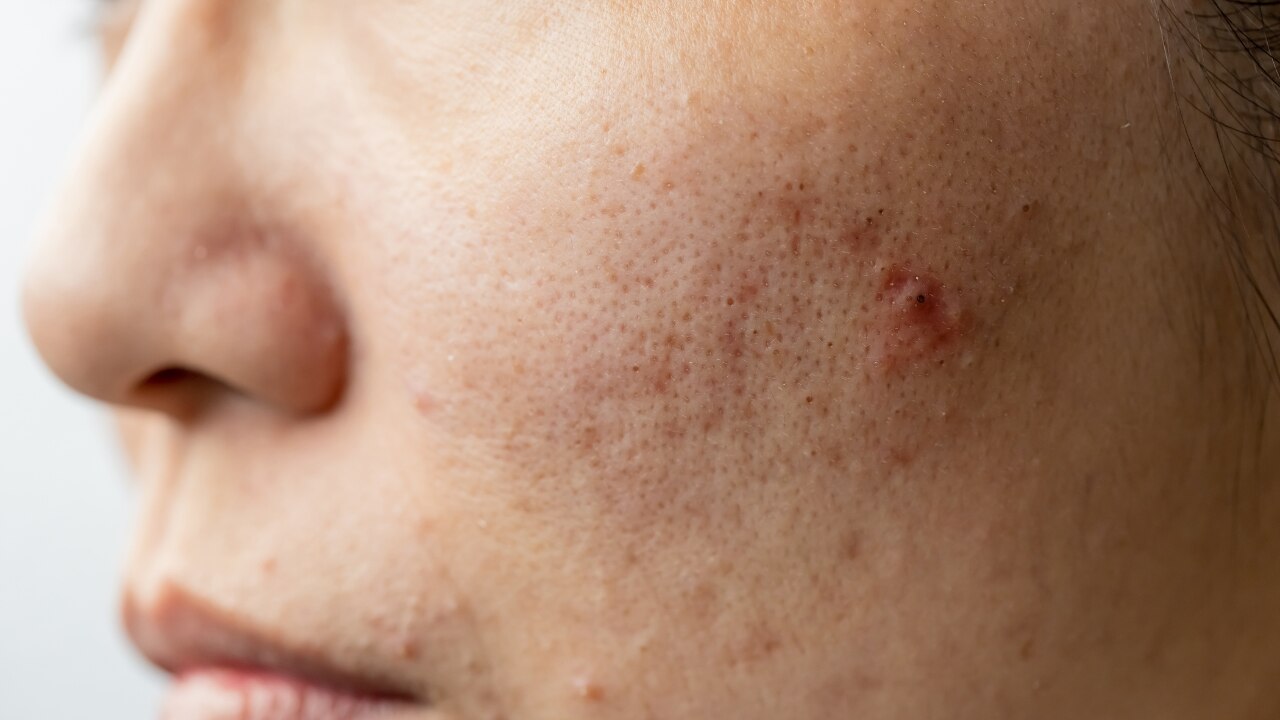 Helps Reduce the Look of Post-Acne Marks