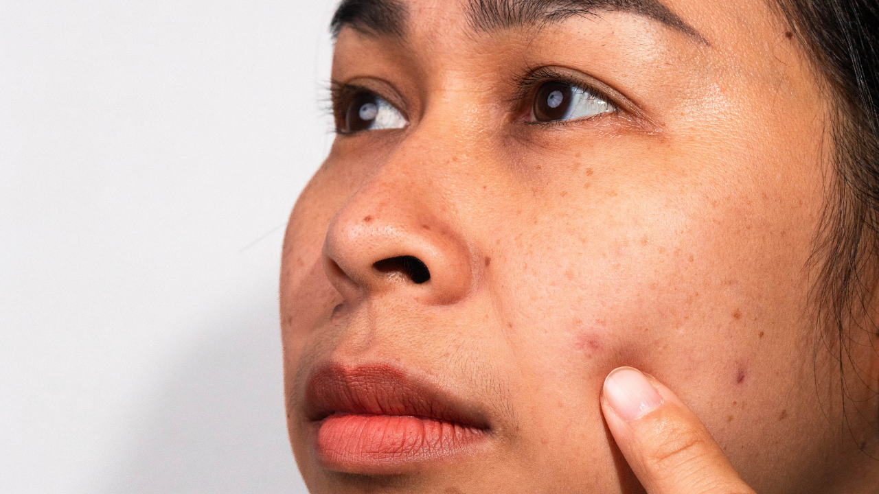 Tranexamic Acid for Dark Spots and Acne Marks